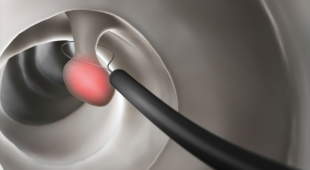 Illustration of a polyp removal. 