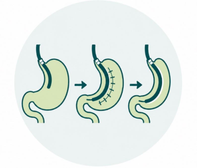 Medical illustration showing an endoscope placing sutures inside the stomach during an endoscopic sleeve gastroplasty (ESG) procedure.