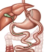 Gastric bypass surgical visual