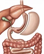 Gastric sleeve visual